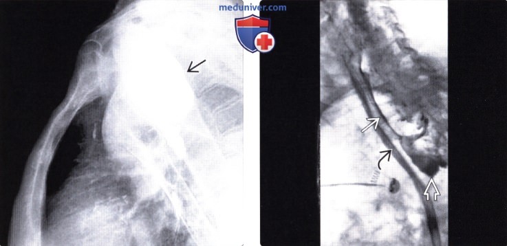 Рентгенограмма (эзофагография) при дивертикуле Ценкера