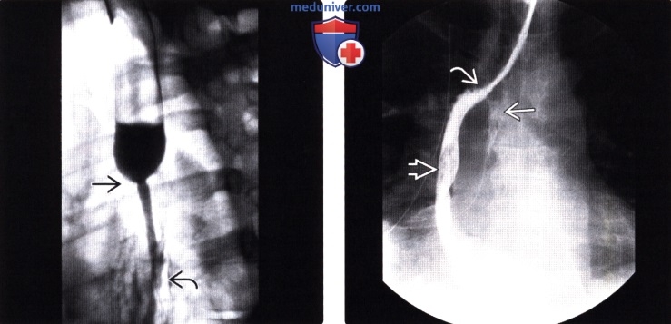 Рентгенография (эзофагография), КТ при эзофагэктомии Айвора Льюиса и других резекциях пищевода
