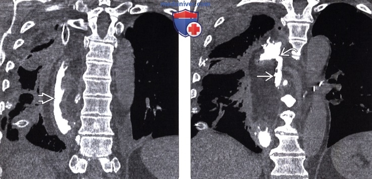 Рентгенография (эзофагография), КТ при эзофагэктомии Айвора Льюиса и других резекциях пищевода