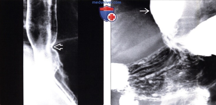 Рентгенограмма (эзофагография) при склеродермии пищевода