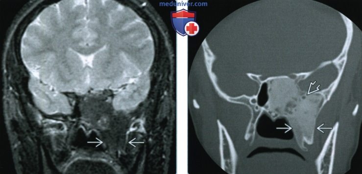 Фиброзная дисплазия основания черепа - лучевая диагностика