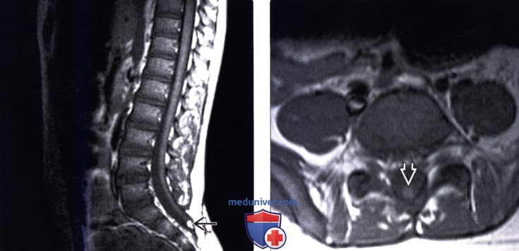Синдром фиксированного спинного мозга мрт thumbnail