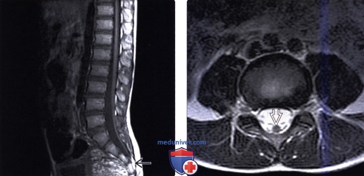 Лечение синдрома фиксированного спинного мозга thumbnail