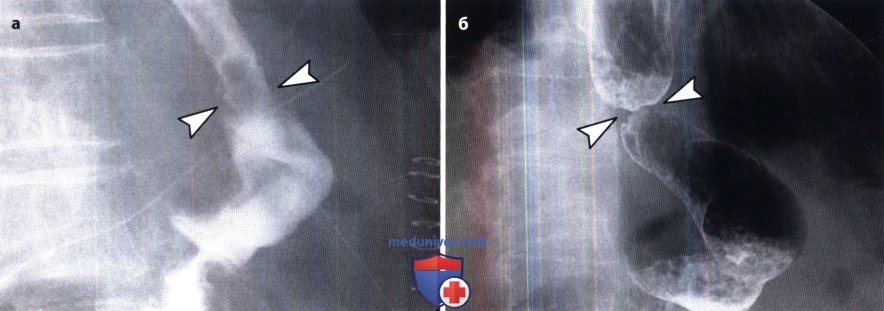 Рентгенограмма при стриктуре анастамоза