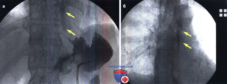Рентгенограмма при послеоперационном гастроэзофагеальном рефлюксе