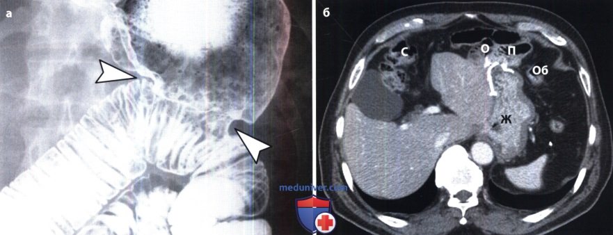 Рентгенограмма, КТ в норме после операции на желудке и двенадцатиперстной кишке