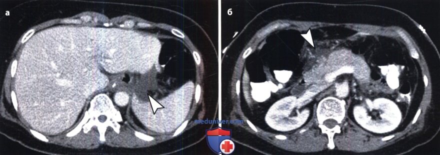 Рентгенограмма, КТ в норме после операции на желудке и двенадцатиперстной кишке