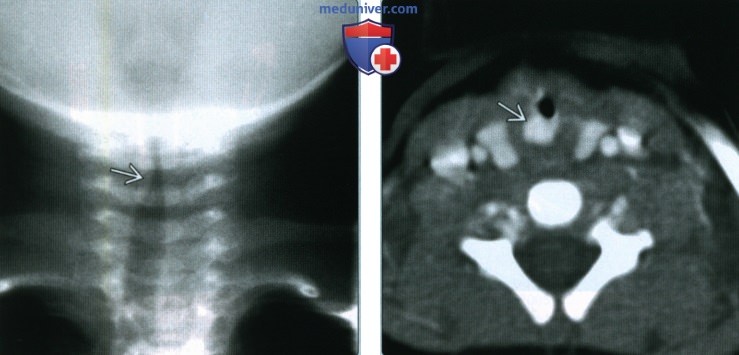 Младенческая гемангиома верхних дыхательных путей - лучевая диагностика