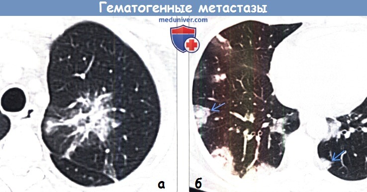 Как выглядят метастазы в легких на кт фото