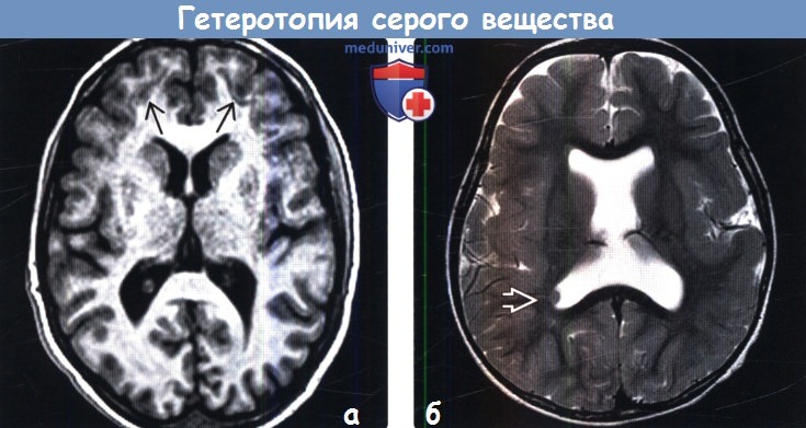 Гетеротопия серого вещества мозга на МРТ