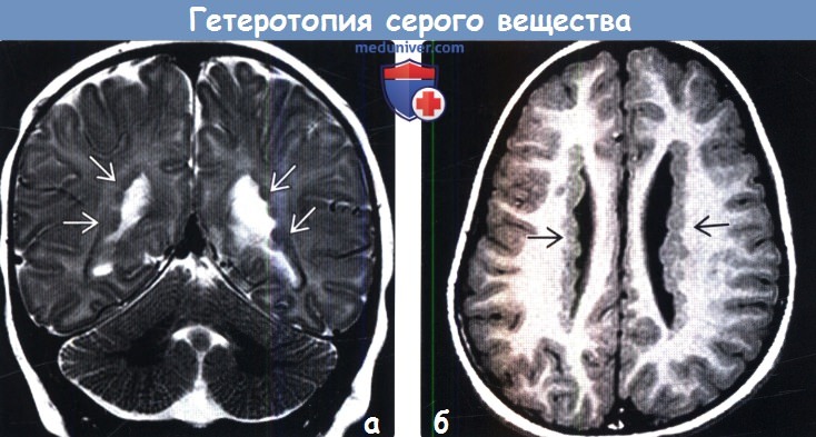 Гетеротопия серого вещества мозга на МРТ