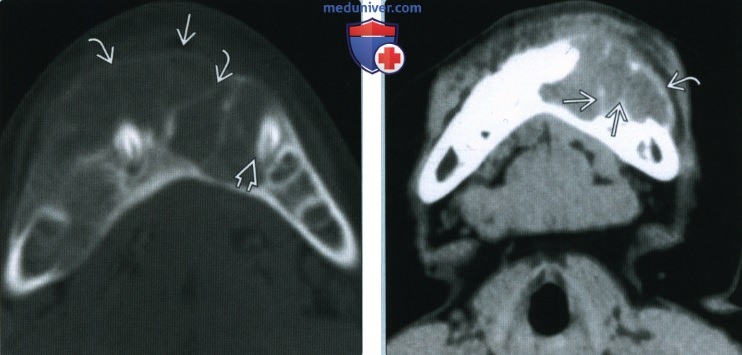 Центральная гигантоклеточная гранулема верхней и нижней челюсти - лучевая диагностика