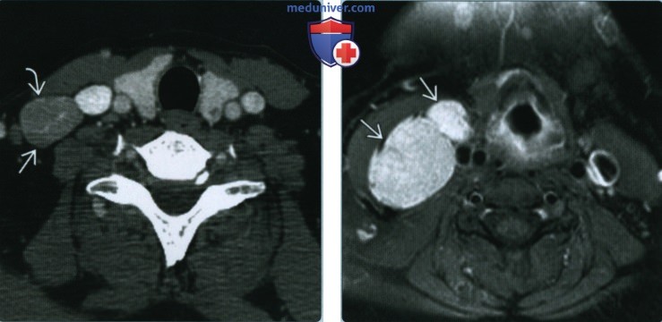 Гигантская гиперплазия лимфатических узлов шеи (болезнь Кастлемана) - лучевая диагностика
