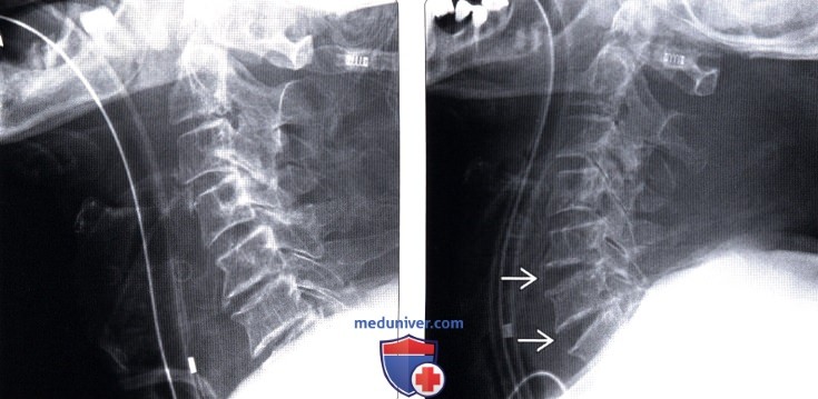 Рентгенограмма при гиперэкстензионной травме шейного отдела позвоночника