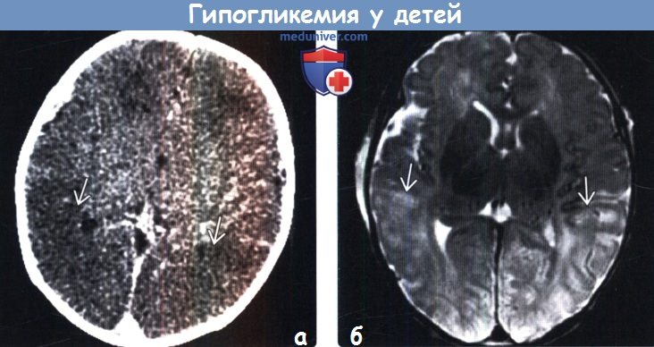 Ишемическая головного мозга новорожденного. Гипоксически-ишемическое поражение головного мозга кт. Гипоксическое поражение головного мозга на мрт. Гипоксическая энцефалопатия на мрт. Гипоксические изменения головного мозга на кт.