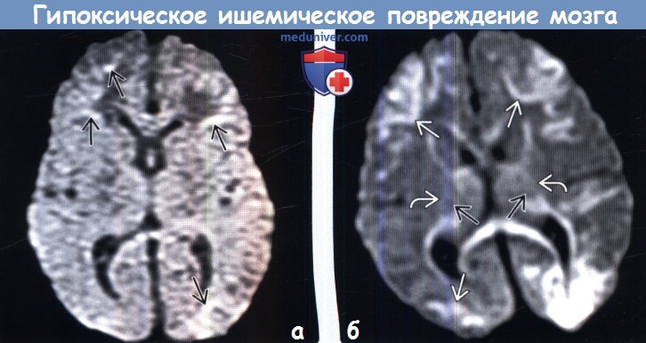 Гипоксическое поражение головного мозга. Гипоксически-ишемическое поражение ЦНС мрт. Гипоксические изменения головного мозга на кт. Гипоксическая энцефалопатия на мрт. Гипоксическое поражение головного мозга на мрт.