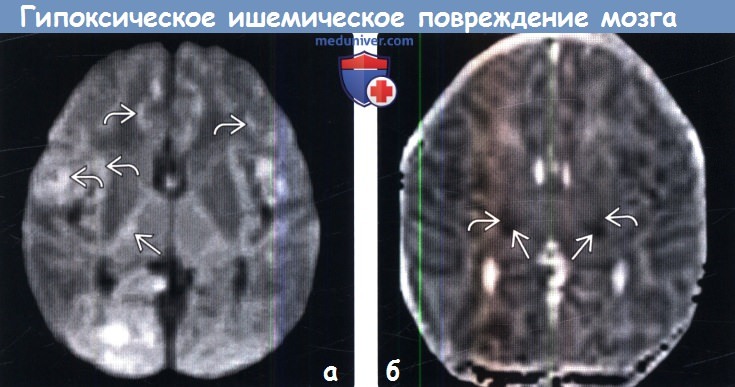 Гипоксия головного мозга у детей мрт thumbnail