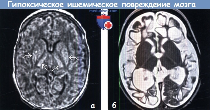 Гипоксическое ишемическое поражение головного мозга на МРТ