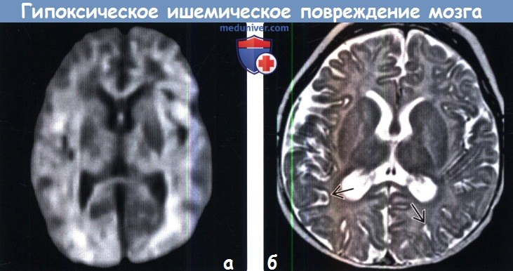Гипоксическое ишемическое поражение головного мозга на МРТ