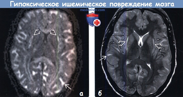 Ишемическая головного мозга новорожденного. Гипоксическая энцефалопатия на мрт. Гипоксически-ишемическое поражение головного мозга кт. Ишемическое поражение головного мозга на мрт. Гипоксия мозга мрт.
