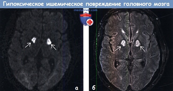 Гипоксическое ишемическое повреждение головного мозга у взрослых на МРТ