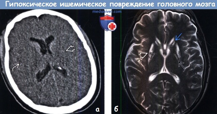 Гипоксическое ишемическое повреждение головного мозга у взрослых на МРТ