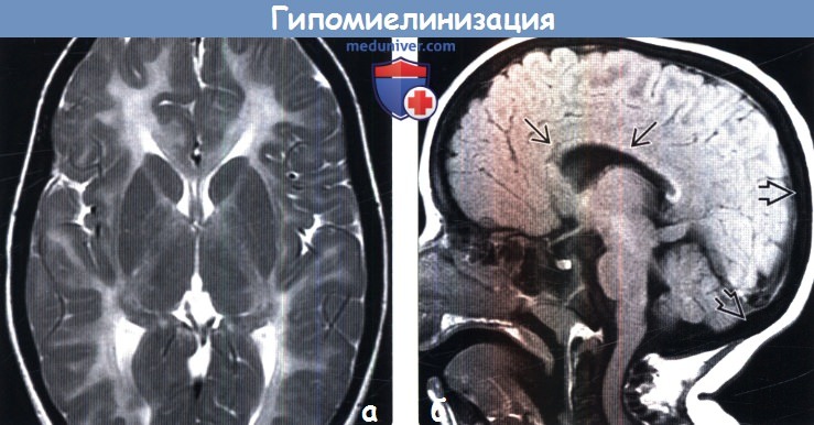 Гипомиелинизация головного мозга на МРТ