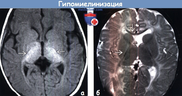 Гипомиелинизация головного мозга на МРТ