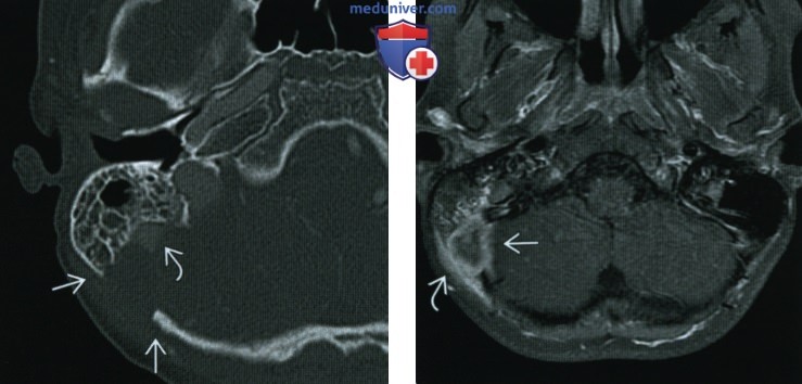 Лангергансоклеточный гистиоцитоз основания черепа - лучевая диагностика