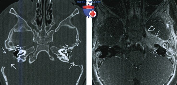 Лангергансоклеточный гистиоцитоз височной кости - лучевая диагностика