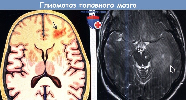 Глиоматоз головного мозга на МРТ