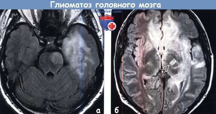 Глиоматоз головного мозга на МРТ