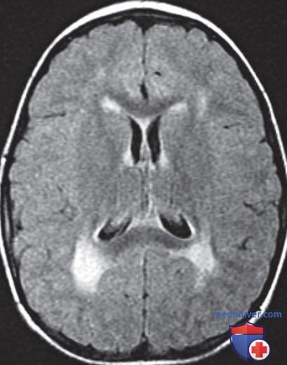 ��� ������� ��������� MELAS � MERRF
