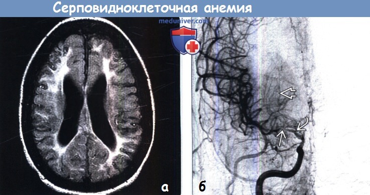 Головной мозг при серповидноклеточной анемии на МРТ, ангиограмме