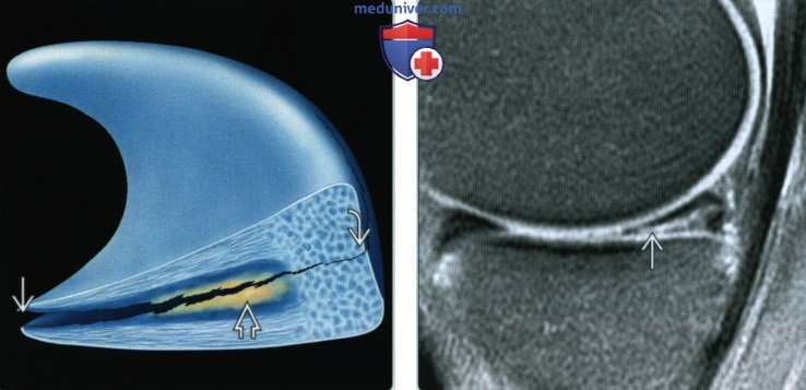 Признаки горизонтального разрыва мениска коленного сустава