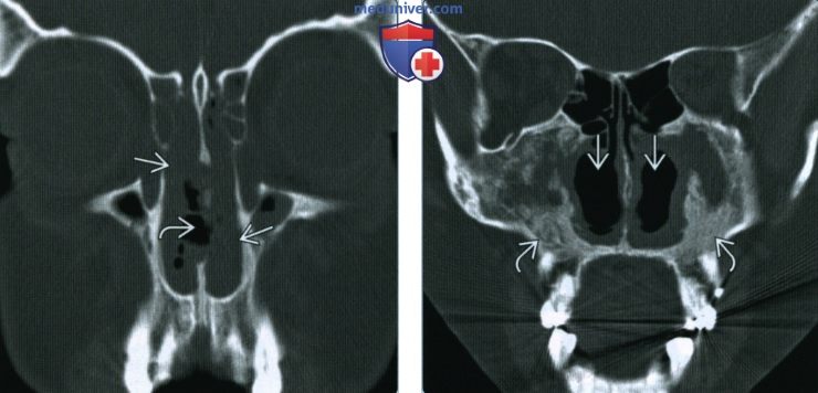 Гранулематоз с полиангиитом (Вегенера) носа, пазухи - лучевая диагностика