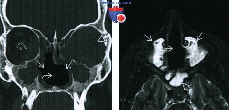 Гранулематоз с полиангиитом (Вегенера) носа, пазухи - лучевая диагностика