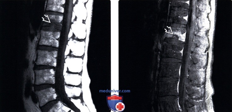 Рентген грыжи шморля в грудном отделе позвоночника thumbnail