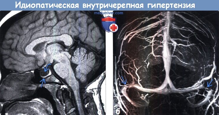Идиопатическая внутричерепная гипертензия на МРТ головного мозга