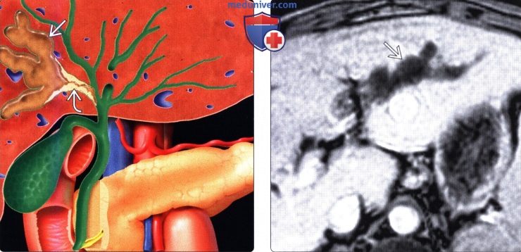 Лучевая диагностика интрадуктальной папиллярной муцинозной опухоли желчного протока