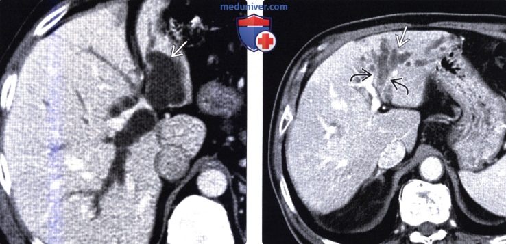 Лучевая диагностика интрадуктальной папиллярной муцинозной опухоли желчного протока