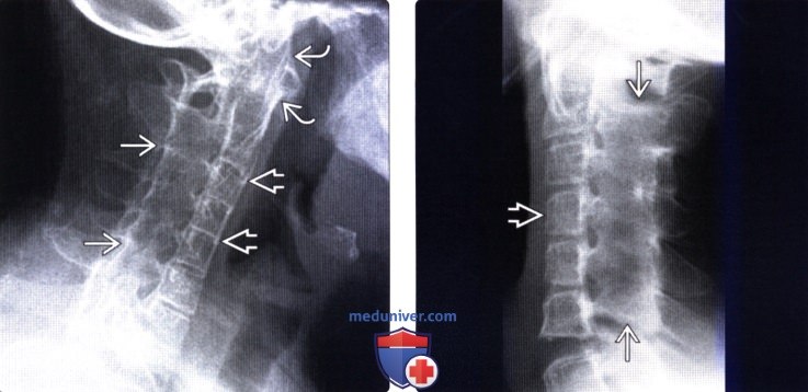 Рентгенограмма позвоночника при ювенильном идиопатическом артрите