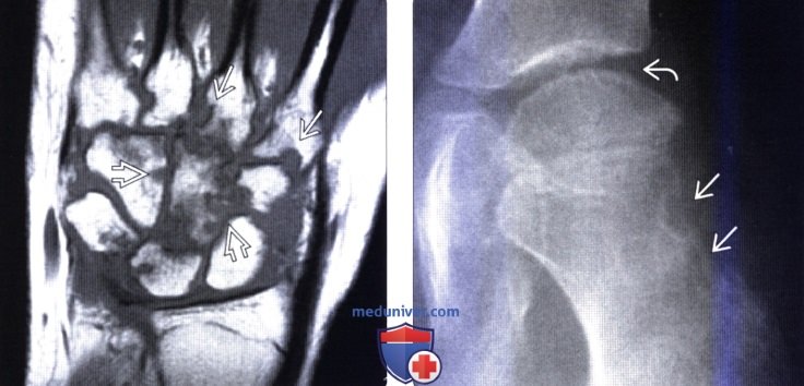 МРТ, рентгенограмма позвоночника при ювенильном идиопатическом артрите