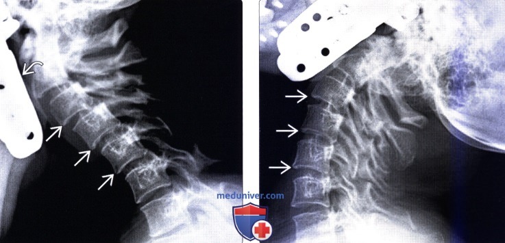 Рентгенограмма позвоночника при ювенильном идиопатическом артрите