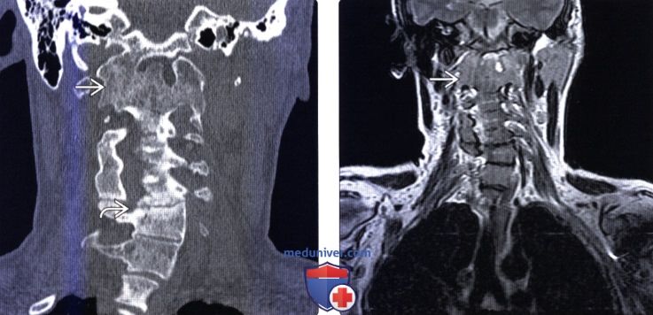 КТ, МРТ позвоночника при ювенильном идиопатическом артрите