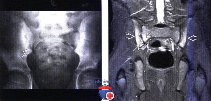 Рентгенограмма, МРТ позвоночника при ювенильном идиопатическом артрите