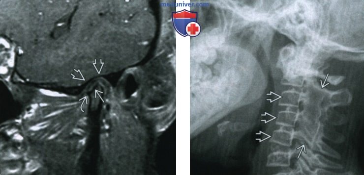 Ювенильный идиопатический артрит височно-нижнечелюстного сустава (ВНЧС) - лучевая диагностика