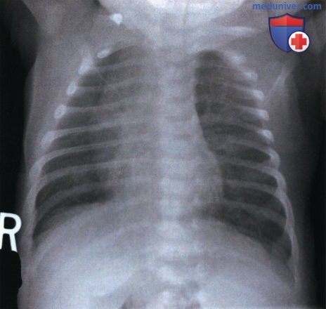 Примеры анализа качества рентгенограмм органов грудной клетки (ОГК) новорожденных и грудных детей в передне-задней проекции (ПЗ)
