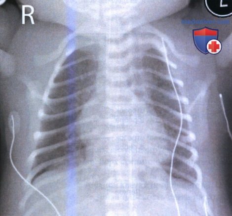 Примеры анализа качества рентгенограмм органов грудной клетки (ОГК) новорожденных и грудных детей в передне-задней проекции (ПЗ)