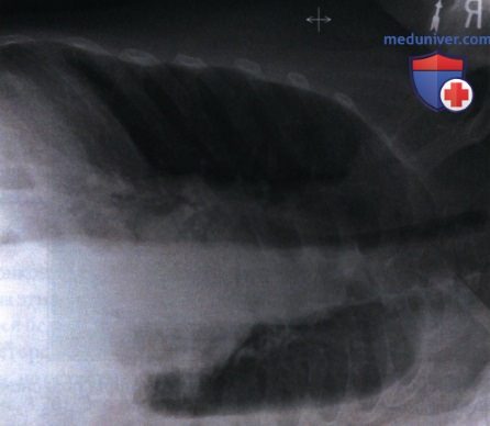 Примеры анализа качества рентгенограмм органов грудной клетки (ОГК) лежа на боку